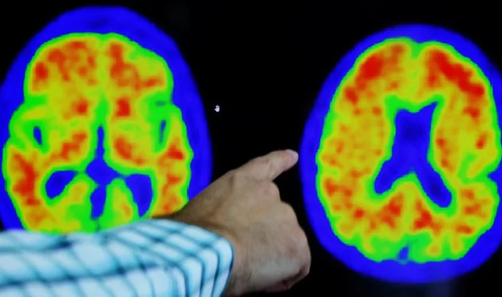 Alzheimer's diagnosis revamp embraces rating scale similar to cancer